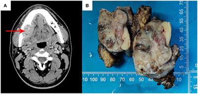 Case report: Primary sarcoma of the mandible with a novel SLMAP-BRAF fusion